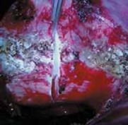 Illustration 18 for Mastering Anterior Interbody Arthrodesis with Instrumentation for Scoliosis