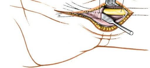 Illustration 20 for Volar Approach: Optimal Exposure for the Volar aspect of the Distal Radius