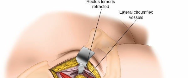 Illustration 89 for Unlocking Every Aspect of the Hip's Surgical Approaches