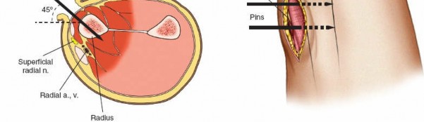 Illustration 16 for Key Approaches for External Fixation: Humerus, Radius, Ulna, Wrist