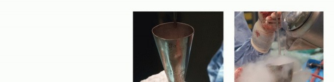 Illustration 7 for Avoid Major Surgery: Bone Tumor Treatment with Liquid Nitrogen Pour