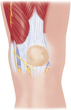 Illustration 2 for Minimal Incision Total Knee: Experience Faster Healing