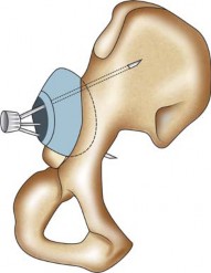 Illustration 111 for Successful Total Hip Replacement in Developmental Dysplasia