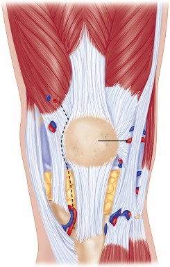 Illustration 6 for Minimal Incision Total Knee: Experience Faster Healing