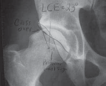 Illustration 4 for Resolving Femoral Head Neck Impingement: Arthroscopic FAI Solutions