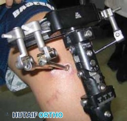 Illustration 19 for Conquering Adolescent Blount's Disease: A Surgical Guide