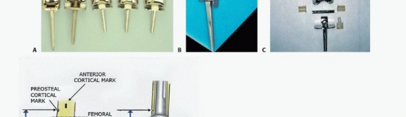 Illustration 6 for Advanced Distal Femoral Resections: Limb-Sparing Outcomes & Techniques