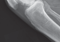 صورة طبية: استبدال مفصل الركبة بالحد الأدنى من التدخل الجراحي: ألم أقل وتعافٍ أسرع مع النهج شبه الرضفي الإنسي