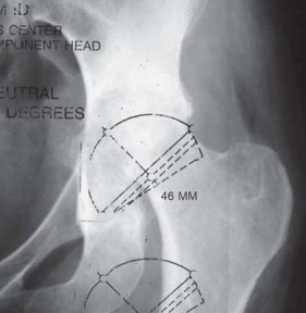 Illustration 17 for Total Hip Replacement for Protrusio: Restore Your Hip Function