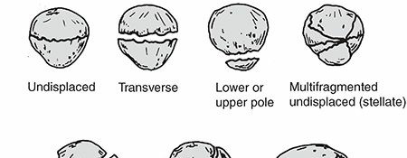 Unraveling Extensor Mechanism Injuries: Patella Function & Trauma