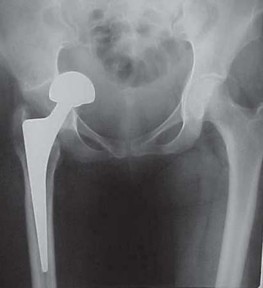 Illustration 9 for Total Hip Replacement for Protrusio: Restore Your Hip Function