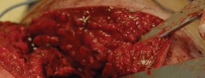 Illustration 107 for Femoral Stem Revision: Posterior Approach for Better Outcomes