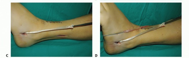 Illustration 42 for Foot Drop Surgery: How a Pin or Drill Elevates Tendon Transfer