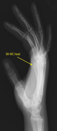 Illustration of carpalmetacarpal joints carpalmetacarpal - Dr. Mohammed Hutaif