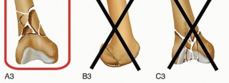 Illustration 12 for Retrograde Femoral Nailing: Optimizing Surgical Outcomes