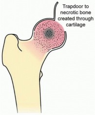 Illustration 8 for Head-Sparing for Osteonecrosis of the Femoral: Preserve Your Hip