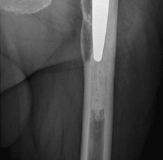 Illustration 6 for Revision THA: Unlocking Stability with Porous Tantalum Cups