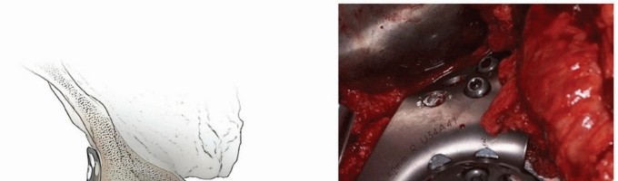 Illustration 13 for Uncemented Acetabular Component: Augments & Cup-Cages for Bone Loss