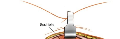 Illustration 89 for Mastering the Approach to the Distal Humerus: Safety & Skills