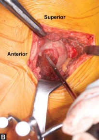Illustration 16 for Avoiding Errors: Navigation in Total Hip Arthroplasty