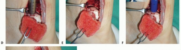 Illustration 28 for Painful Talus Lesions? The tech fig c Osteochondral Transfer Solution
