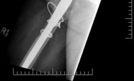 Illustration 10 for Solving Severe Acetabular Bone Loss with Cup-Cage Reconstruction