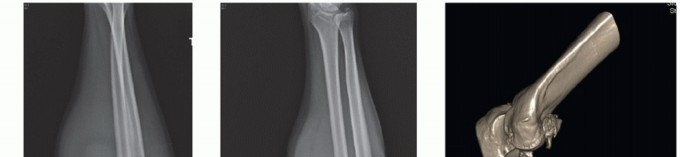 Illustration 9 for Radial Head & Neck Fractures: Mastering ORIF for Best Results