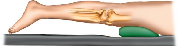 Illustration 36 for Surgical Access: Mastering the Tibia's Surface & Fibula Approaches