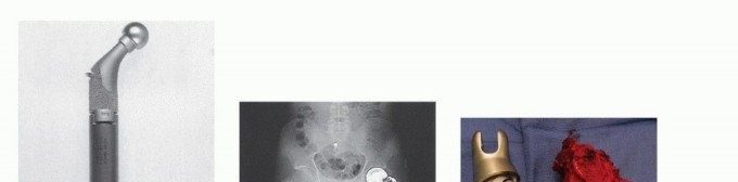 Illustration 8 for Distal Femoral Replacement: Key to Modern Limb Salvage