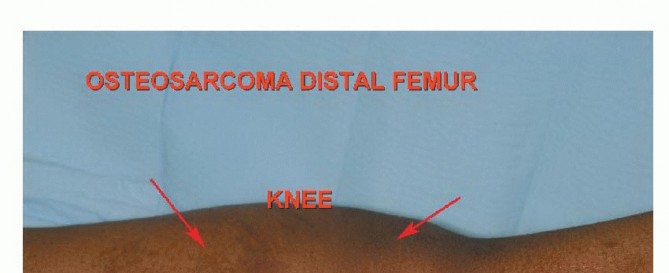 Illustration 8 for Advanced Distal Femoral Resections: Limb-Sparing Outcomes & Techniques