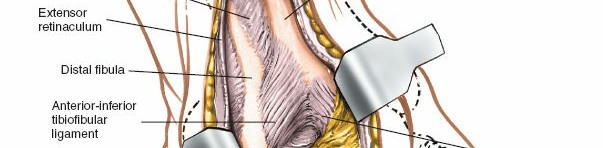 Illustration 95 for Optimized Approaches to the Dorsum of the Foot & Ankle