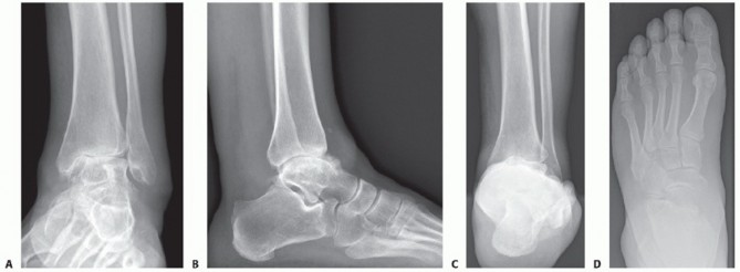 Illustration 3 for HINTEGRA Total Ankle: Unlocking Natural Ankle Movement