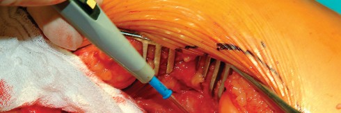 Illustration 41 for Direct Lateral Hip: Optimize Exposure with Sharp Curved Hohmann