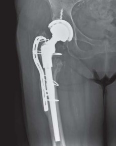 Illustration 24 for Effective Arthroplasty for Salvage of Failed Hip Fixation