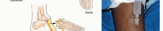 Illustration 27 for Treating Tumors of the Foot: Optimizing Amputation & Resection