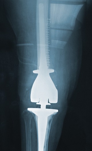Illustration 19 for Hinged Total Knee: The Salvage Solution for Challenging Cases