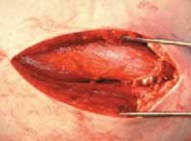 Illustration 29 for Increased Femoral Anteversion: A Proximal Femoral Rotational Osteotomy