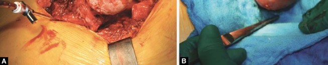 Illustration 79 for Birmingham Hip Resurfacing Designer's Technique for Active Lives