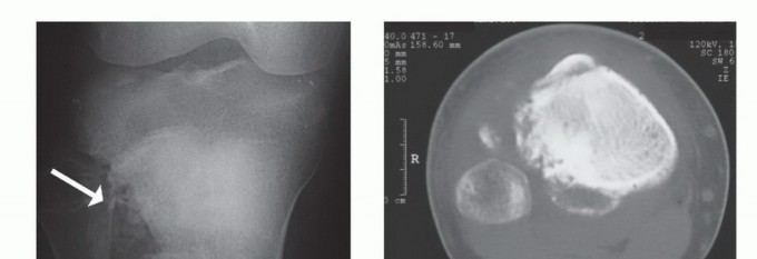 Illustration 9 for Tackling Complex Tumors of the Proximal Tibia: Limb-Sparing Solutions