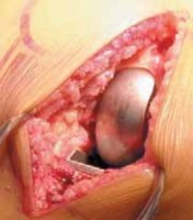 Illustration 21 for Knee Arthroplasty Unicondylar: Discover if Partial Knee Replacement is Right
