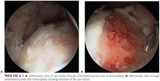 Illustration 149 for Precision Hip Arthroscopy: Unlock Access to the Peripheral Compartment