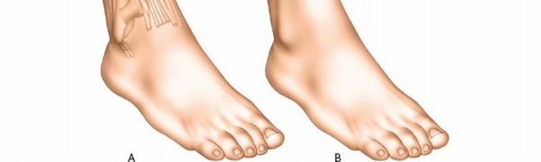 Illustration 112 for Surgical Access: Mastering the Tibia's Surface & Fibula Approaches