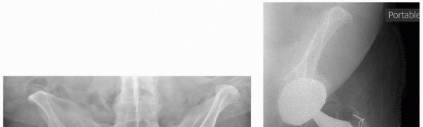 Illustration 5 for Sliding Trochanteric Osteotomy: Modern Role & Refined Techniques