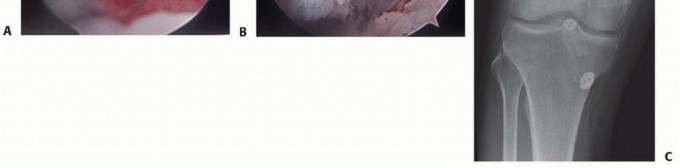 Illustration 25 for Posterior Cruciate Ligament Surgery: Regain Knee Strength & Stability