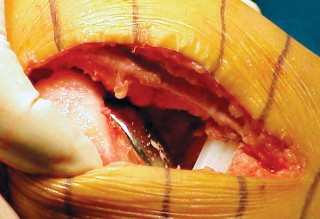 صورة طبية: جراحة استبدال مفصل الركبة الجزئي (UKA): تجنب الأخطاء والاستفادة القصوى في صنعاء مع الأستاذ الدكتور محمد هطيف