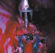 Illustration 22 for Mastering Anterior Interbody Arthrodesis with Instrumentation for Scoliosis