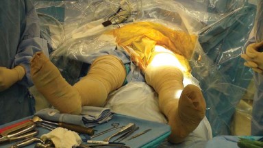 Why the Anterior Approach for Total Hip is Gaining Popularity