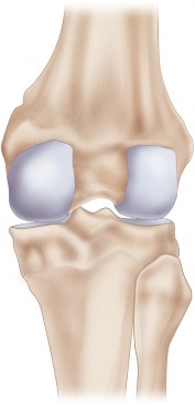 Illustration 20 for Mastering Valgus Total Knee Replacement: Techniques & Pitfalls