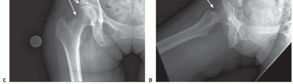 Illustration 5 for Anterior FAI Relief: Mini-Open Anterior Approach Explained