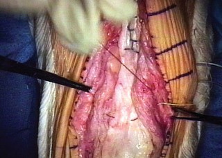 Illustration 17 for Extensor Reconstruction in Total Knee Arthroplasty: Essential Strategies